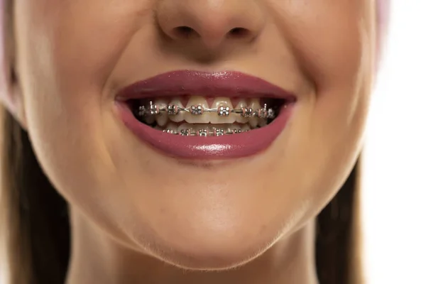 Zbliżenie Uśmiechniętej Młodej Kobiety Aparatem Zębach — Zdjęcie stockowe