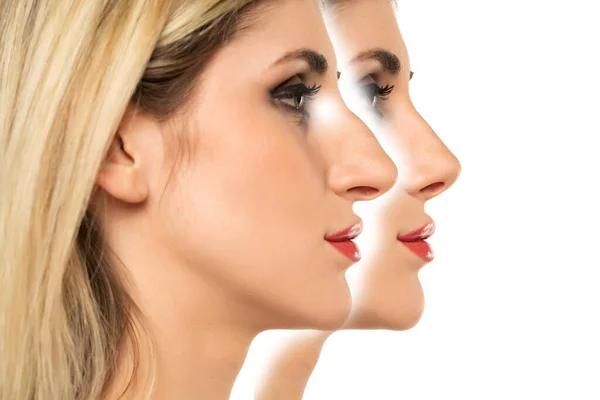 Young woman before and after plastic surgery of the nose on a white background.