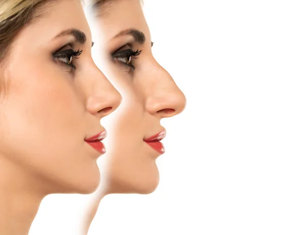 Wanita Muda Sebelum Dan Setelah Operasi Plastik Hidung Pada Latar — Stok Foto