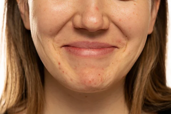 Young Smiling Woman Pimples Her Face Problematic Skin Close — Photo