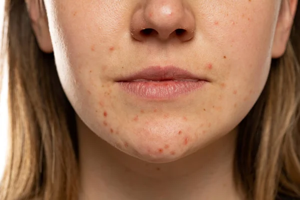 Young woman with the pimples on her face. Problematic skin. Close-up