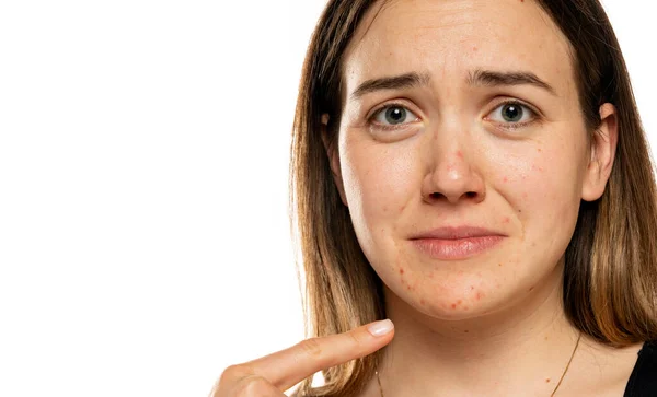 Young Unhapy Woman Pimples Her Face Problematic Skin — Stockfoto