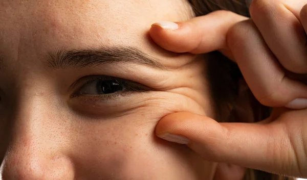 Jonge Vrouw Tonen Haar Oog Rimpels Met Haar Vingers Een — Stockfoto