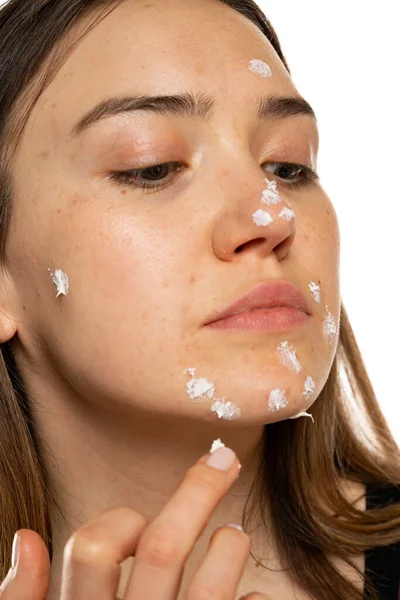 Woman Applying Acne Cream Her Face Solving Acne Inflammation Her — 图库照片