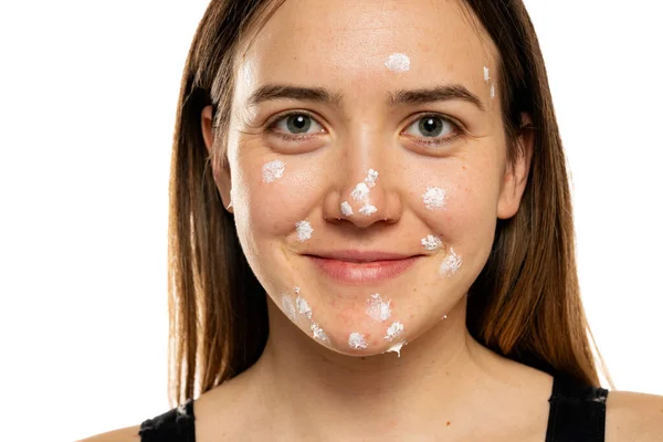 Young Smiling Woman Acne Cream Her Face Solving Acne Inflammation — Stock Fotó