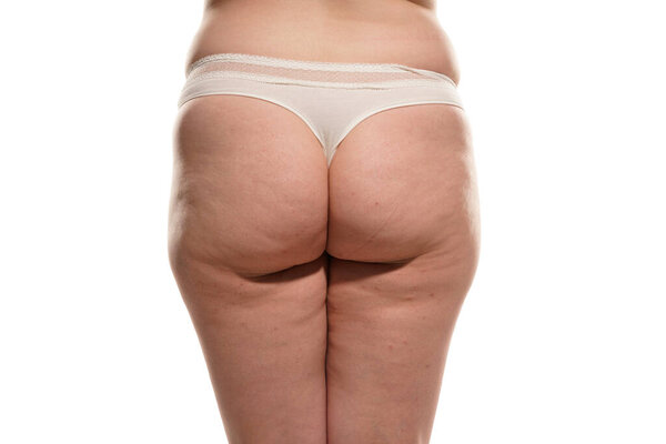 Overweight woman with fat cellulite legs and buttocks, obesity female body, white background.