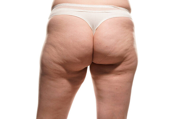 Overweight woman with fat cellulite legs and buttocks, obesity female body, white background.