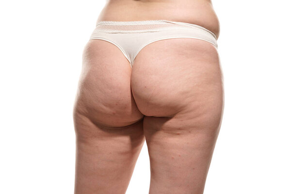 Overweight woman with fat cellulite legs and buttocks, obesity female body, white background.