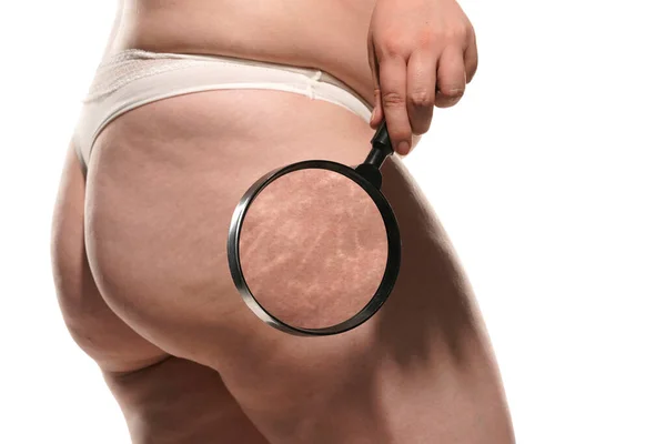 Stretch Marks Women Hips Seen Magnifying Glass — Stock Photo, Image
