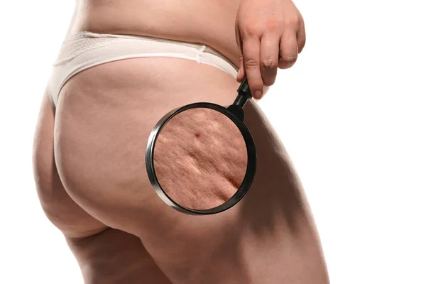 Stretch Marks Women Hips Seen Magnifying Glass — Stock Photo, Image