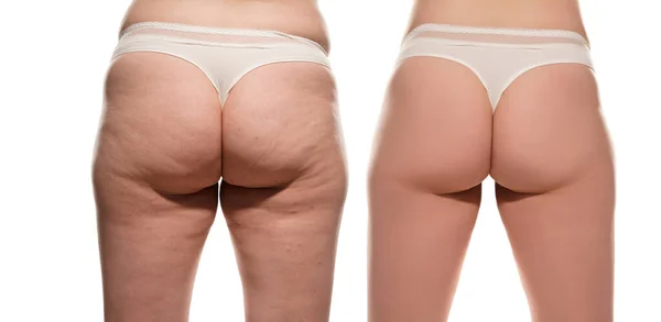 Female Buttocks Treatment — Stock Photo, Image