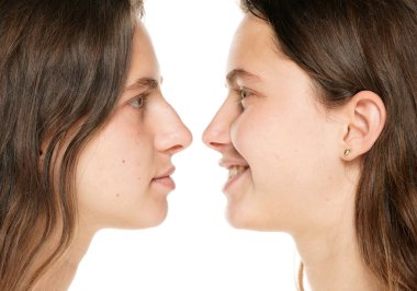 Young smiling woman before and after plastic surgery of the nose on a white background.