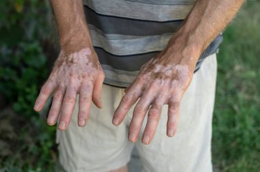 Bir erkeğin ellerindeki deride vitiligo belirtileri.