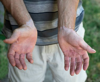 Bir erkeğin ellerindeki deride vitiligo belirtileri.