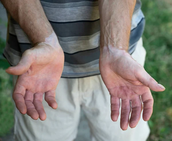 Symptoms Vitiligo Skin Hands Man — 图库照片