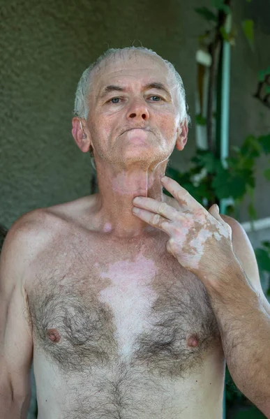 Symptoms of vitiligo on the skin of a man