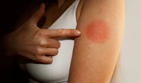 Вакцинационная Реакция Руку Женщины После Инъекции Коронной Вирусной Вакцины Женщины — стоковое фото