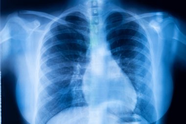 Akciğer kaburgaları x-ray tarama sonuçları.