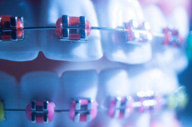 Modern metal parantez hizalayıcıları dişçiler tarafından dişlerin hizalanmasını düzeltmek için kullanılır.