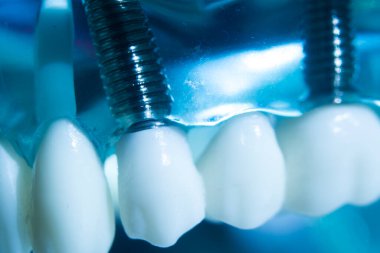 Diş macunu implantı. Diş ve sakız gösteren bir model..