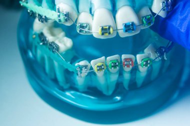 Modern metal parantez hizalayıcıları dişçiler tarafından dişlerin hizalanmasını düzeltmek için kullanılır.