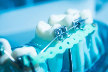 Modern metal parantez hizalayıcıları dişçiler tarafından dişlerin hizalanmasını düzeltmek için kullanılır.