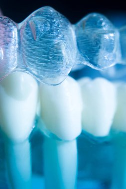 Modern görünmez parantez hizalayıcıları dişçiler tarafından dişlerin hizalanmasını düzeltmek için kullanılır.
