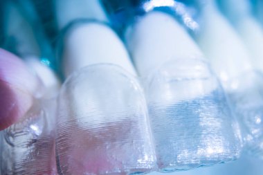 Modern görünmez parantez hizalayıcıları dişçiler tarafından dişlerin hizalanmasını düzeltmek için kullanılır.