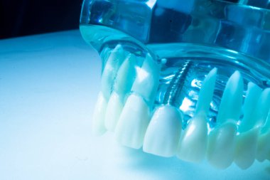 Modern görünmez parantez hizalayıcıları dişçiler tarafından dişlerin hizalanmasını düzeltmek için kullanılır.