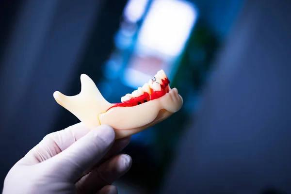 Caries Dental Dentistas Modelo Dental Dientes Encías Conducto Radicular — Foto de Stock