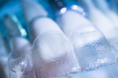 Modern görünmez parantez hizalayıcıları dişçiler tarafından dişlerin hizalanmasını düzeltmek için kullanılır.