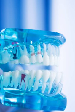 Diş çürüğü modeli dişlerdeki bakterileri gösteriyor.