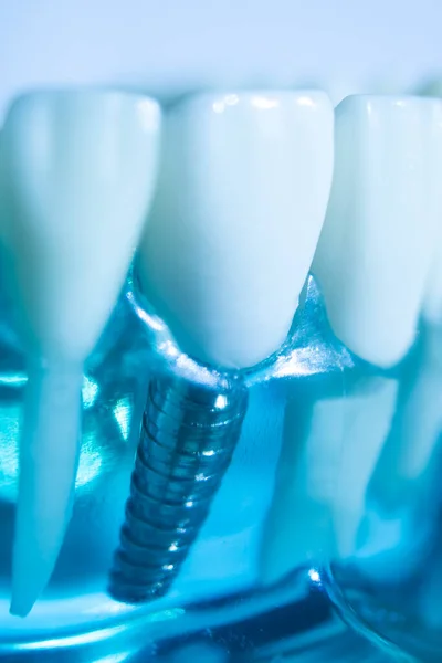 Modelo Enseñanza Odontología Implantes Metal Dental Que Muestra Dientes Encías — Foto de Stock