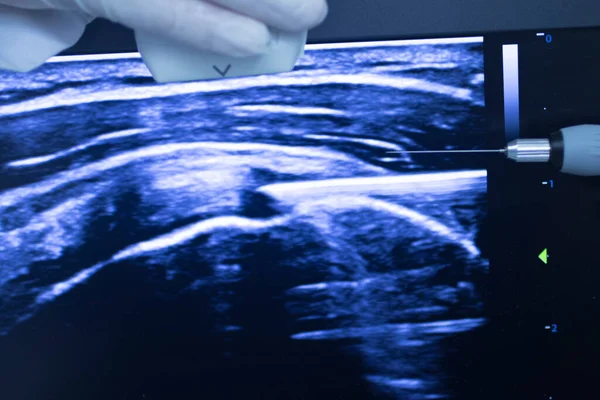 Epi Intratissue Перкутанный Электролиз Сухого Иглоукалывания Экография Сканирования Физиотерапии Медицинское — стоковое фото