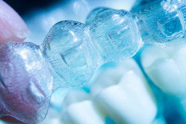 Modern görünmez parantez hizalayıcıları dişçiler tarafından dişlerin hizalanmasını düzeltmek için kullanılır.