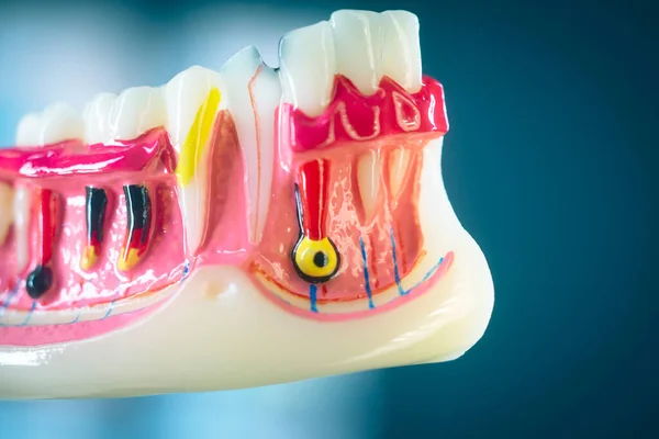 Zubní Kaz Zubní Lékaři Zubní Model Zubů Dásní Kořenového Kanálu — Stock fotografie