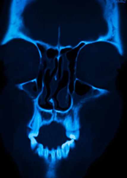 Röntgenbild Schädel Nase Medizinische Untersuchung Ergebnisse Aus Klinik — Stockfoto