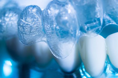 Modern görünmez parantez hizalayıcıları dişçiler tarafından dişlerin hizalanmasını düzeltmek için kullanılır.