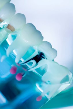 Diş çürüğü modeli dişlerdeki bakterileri gösteriyor.