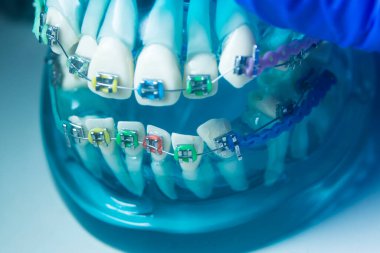 Modern metal parantez hizalayıcıları dişçiler tarafından dişlerin hizalanmasını düzeltmek için kullanılır.