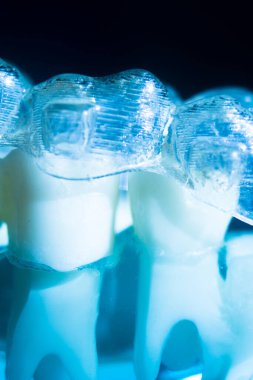 Modern görünmez parantez hizalayıcıları dişçiler tarafından dişlerin hizalanmasını düzeltmek için kullanılır.