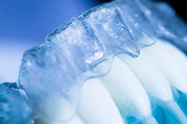 Modern görünmez parantez hizalayıcıları dişçiler tarafından dişlerin hizalanmasını düzeltmek için kullanılır.