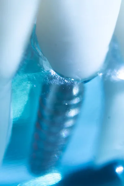 치아와 잇몸을 교육용 금속임 — 스톡 사진