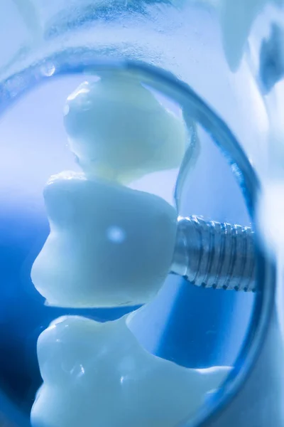 Tandheelkundig Metaal Implantaat Tandheelkunde Onderwijs Model Tonen Tanden Tandvlees — Stockfoto