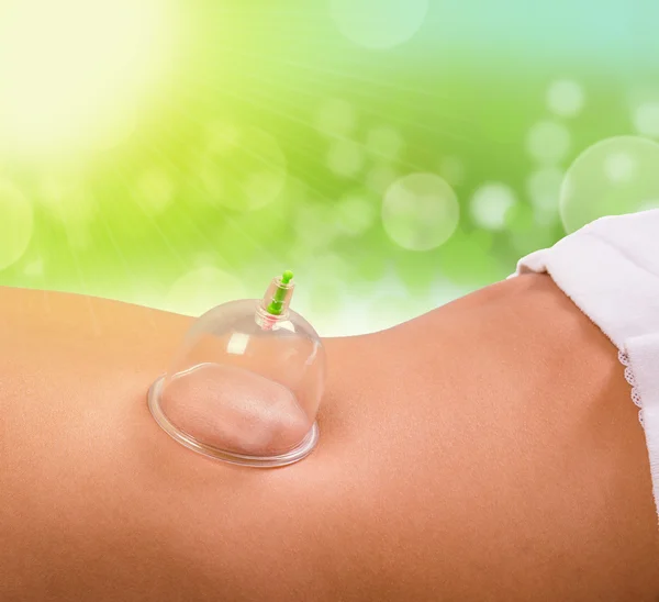 Cupping Terapia — Foto Stock