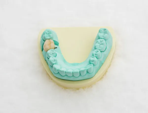 Coroa dentária — Fotografia de Stock