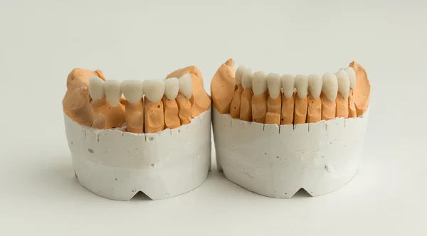 Keramische Zahnkrone — Stockfoto