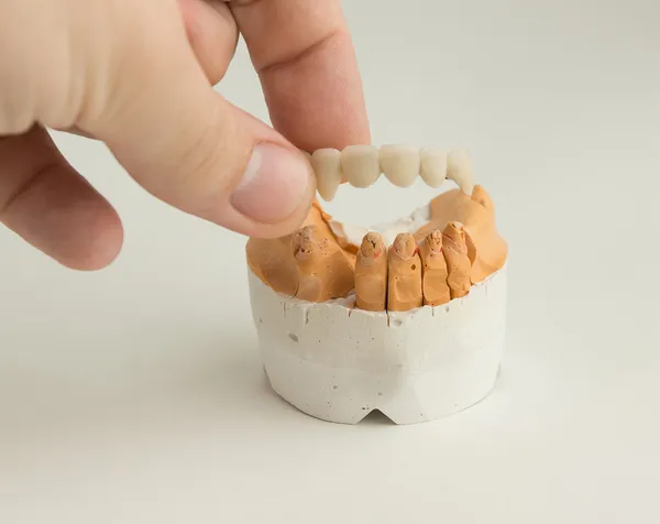 Corona dental de cerámica — Foto de Stock