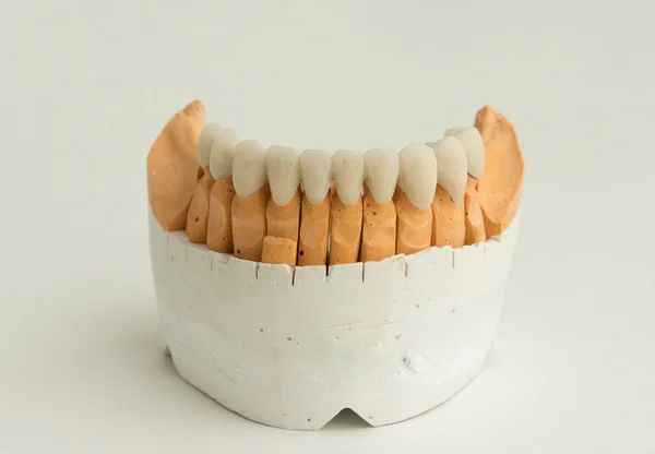 Ceramic dental crown — Stock Photo, Image