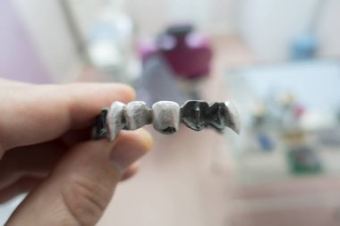 Üretim sürecinde metal diş köprüsü